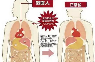 镜面人生，一次肺炎确诊的意外发现