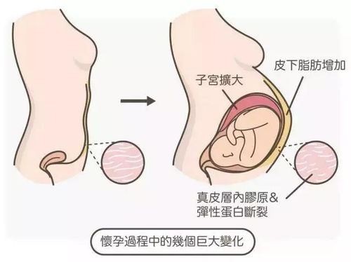 30周胎儿子宫内溺水的医学解析与预防策略